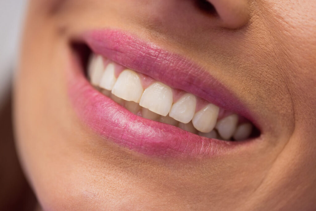 Close de sorriso feminino com dentes recuperados e alinhados após tratamento de desgaste por bruxismo na Clínica Herrera Prime em São José dos Campos.