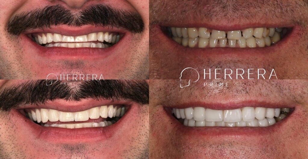 Antes e depois de dentes pequenos e quebradiços recuperados de bruxismo na clínica Dra Fernanda Herrera em São José dos Campos. 